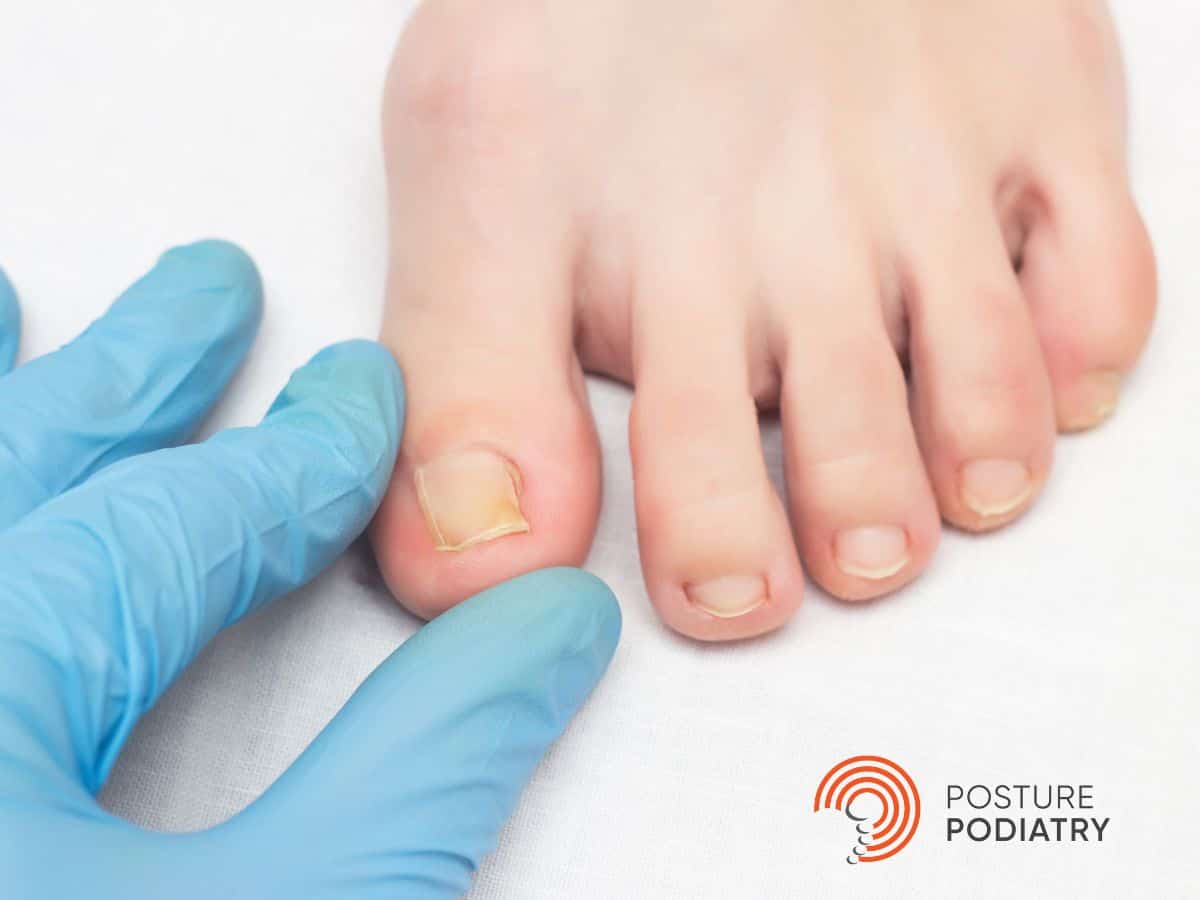 Ingrown Toenail Treatment Photo